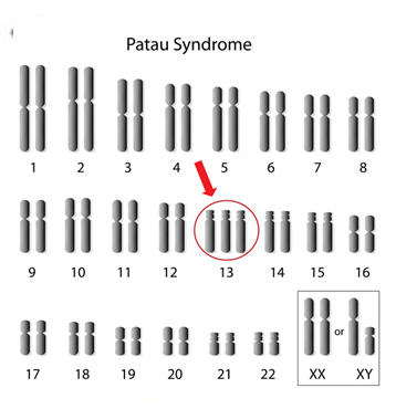 Cariotipo anomalo, trisomia cromosoma 13
